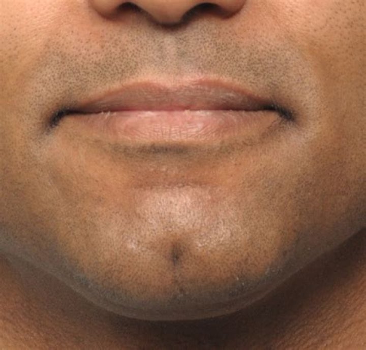 Chin indentation