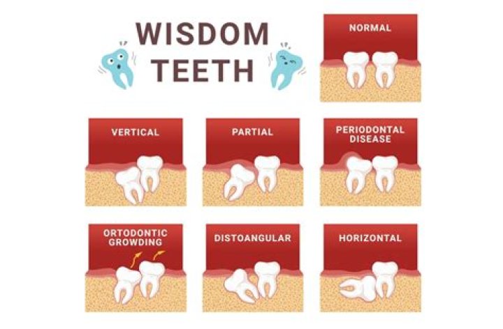 Wisdom tooth for example
